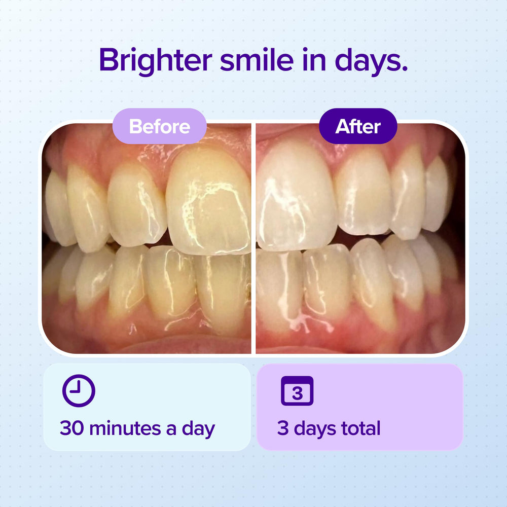 Burst bandeja flexible en detalle, ajusta 360° al arco dental para cobertura uniforme