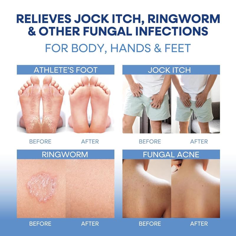 Hermon crema aplicada en cuero cabelludo para aliviar foliculitis y picor