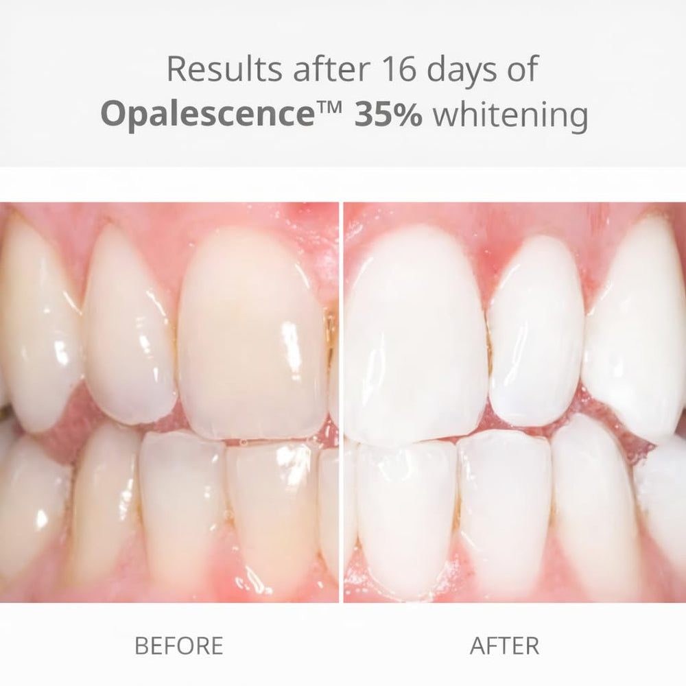 Jeringa Opalescence en primer plano que facilita aplicación precisa