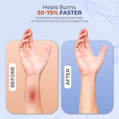 BurnFIX gel refrigerante en tubo para alivio inmediato y enfriamiento prolongado