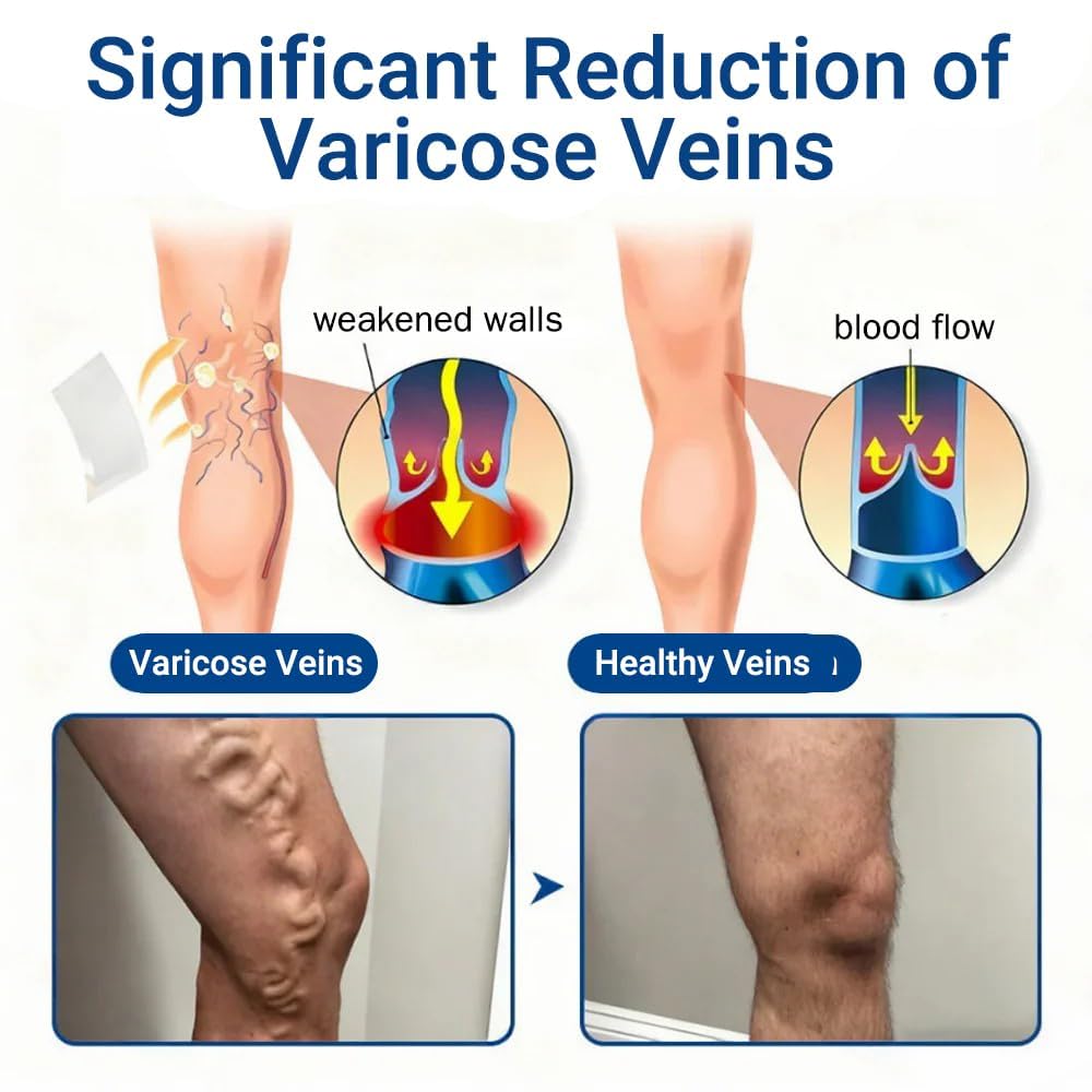 cxuhui Vein Ease parche aplicado en la pierna, aporta comodidad y discreción