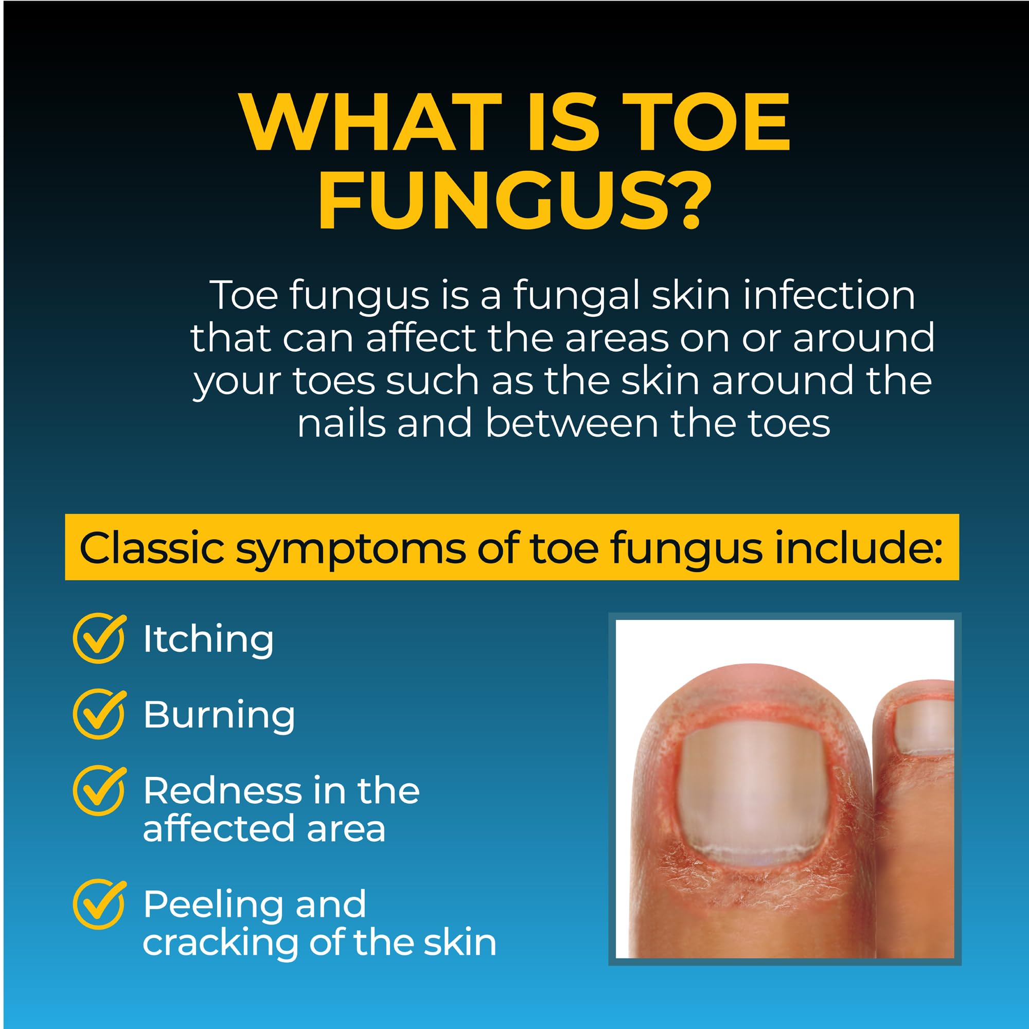 Fungi-Nail aplicándose sobre uña del pie para tratamiento localizado