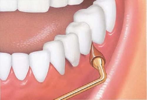 GUM Stimulator guardado en estuche portátil para llevar y mantener higiene