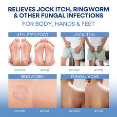 Hermon crema aplicada en cuero cabelludo para aliviar foliculitis y picor