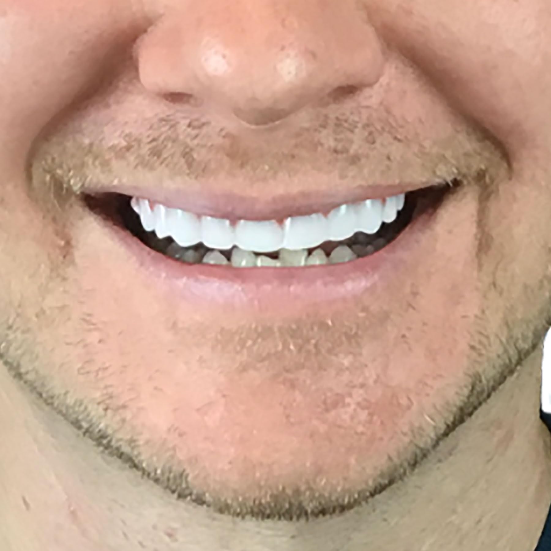 Instant Smile colocación en boca demostrando mejora estética rápida