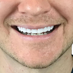 Instant Smile colocación en boca demostrando mejora estética rápida