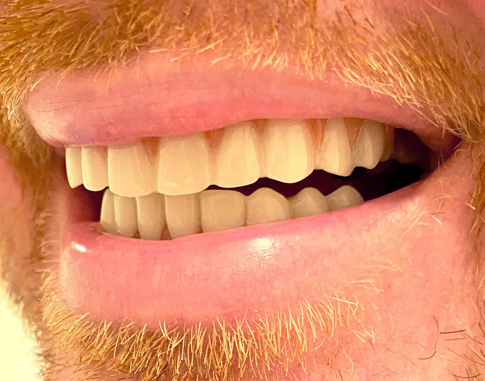 Instant Smile piezas colocadas en boca durante uso para comprobar sonrisa más uniforme