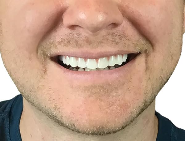 Instant Smile persona usando la pieza superior para mejorar la sonrisa en eventos