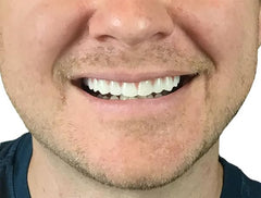 Instant Smile persona usando la pieza superior para mejorar la sonrisa en eventos