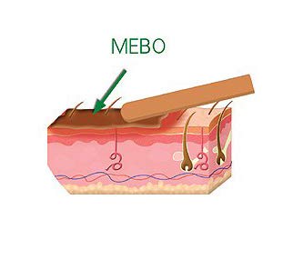 MEBO aplicado en una herida cubierta con venda, ayuda en cuidado y protección