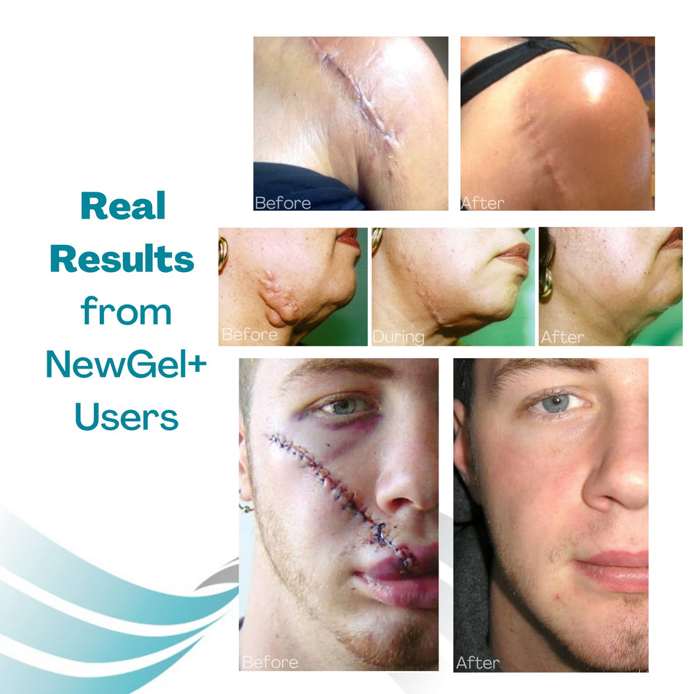Escena clínica con producto MyNewGel en entorno de recuperación segura