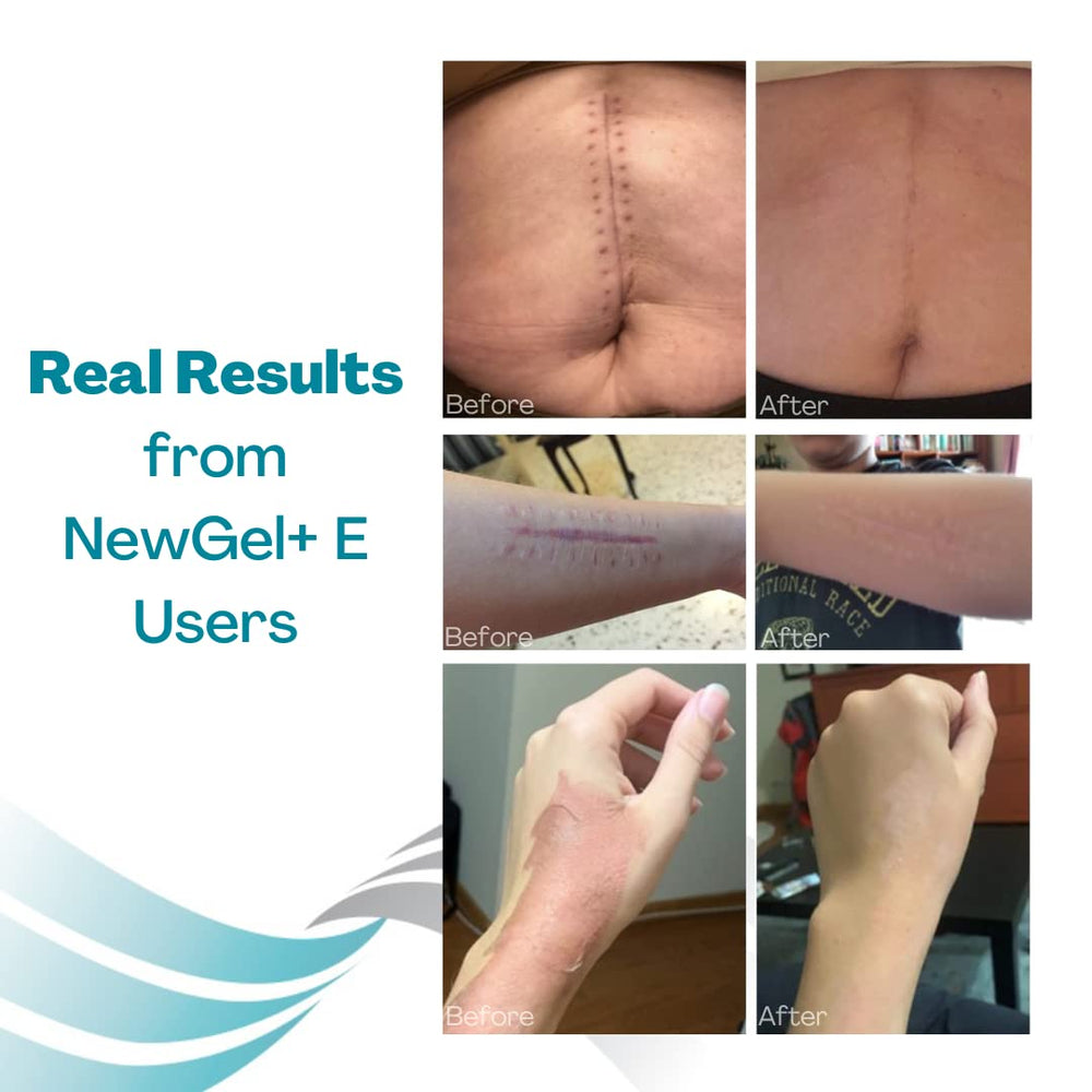 MyNewGel gel transparente sobre cicatriz mostrando cobertura discreta