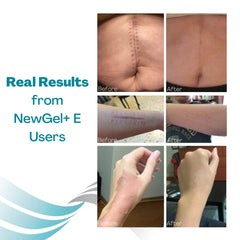 MyNewGel gel transparente sobre cicatriz mostrando cobertura discreta