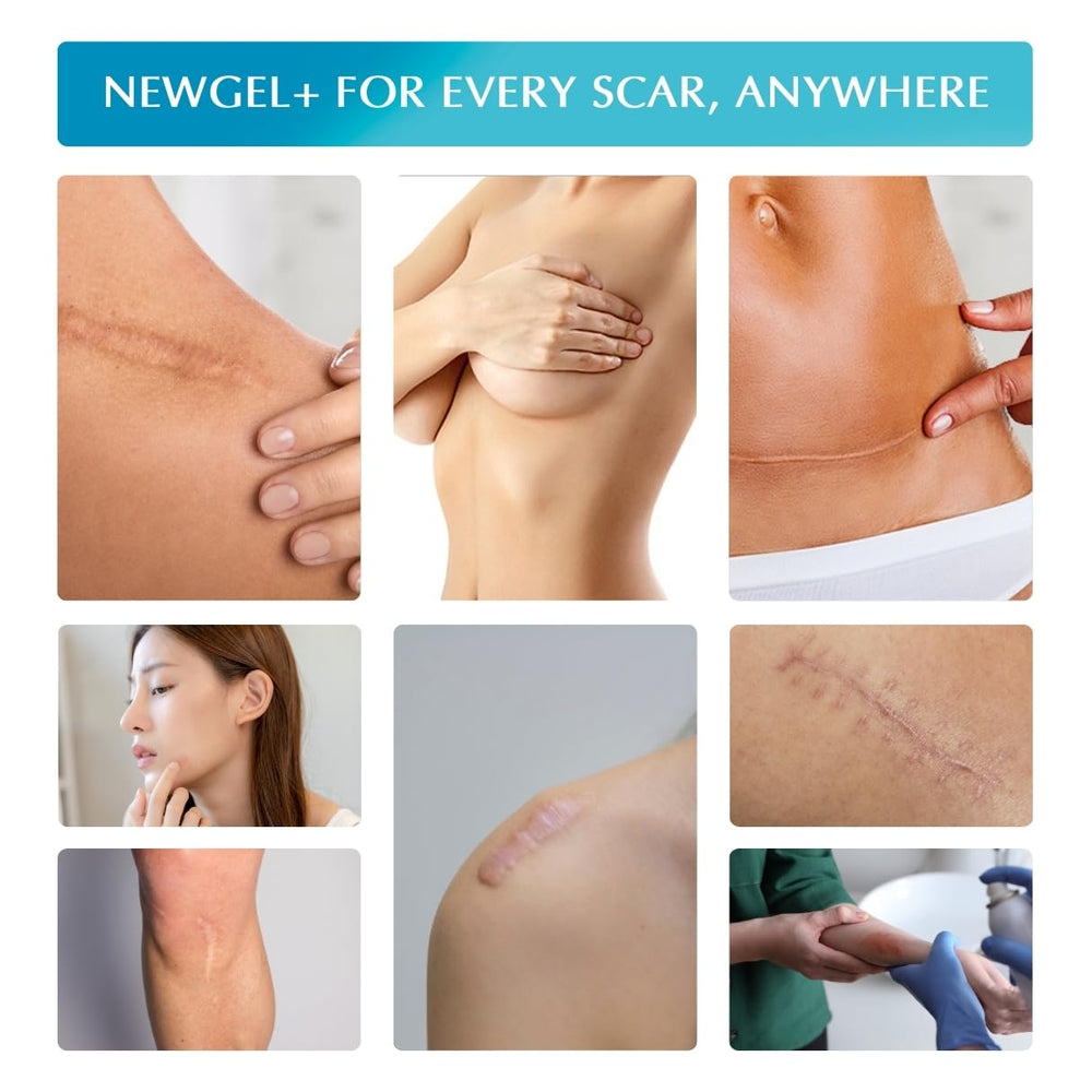 MyNewGel antes y después en cicatriz leve, mejora estética y confort aparente