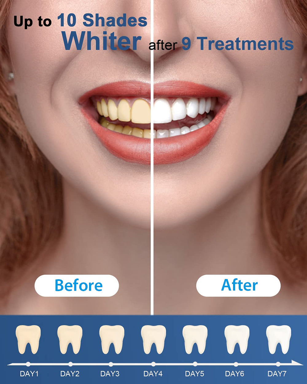 MySmile persona usando bandeja con gel para sonrisa más blanca