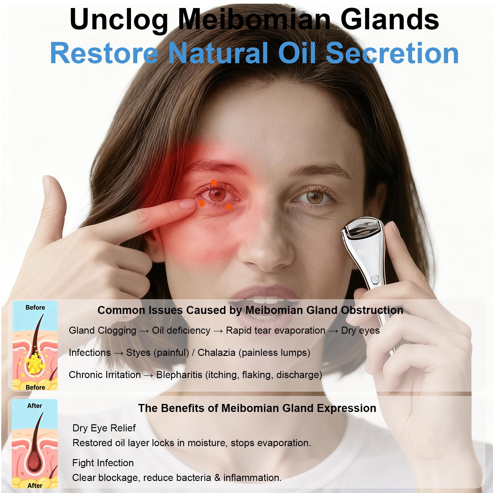 NKQ rodillo en uso sobre párpado ayudando a mejorar flujo glandular