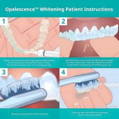 Opalescence jeringa junto a un aligner demostrando compatibilidad y conveniencia