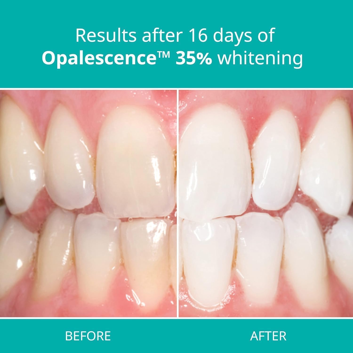 Opalescence textura cremosa del gel destacando adhesión y control