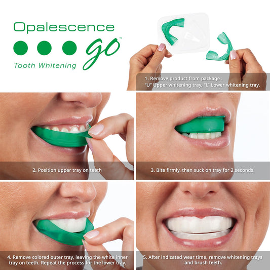 Detalle de bandeja UltraFit de Opalescence adaptándose a la sonrisa para comodidad