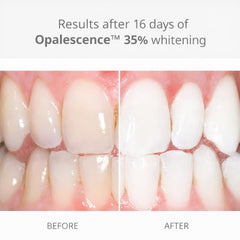 Jeringa Opalescence en primer plano que facilita aplicación precisa