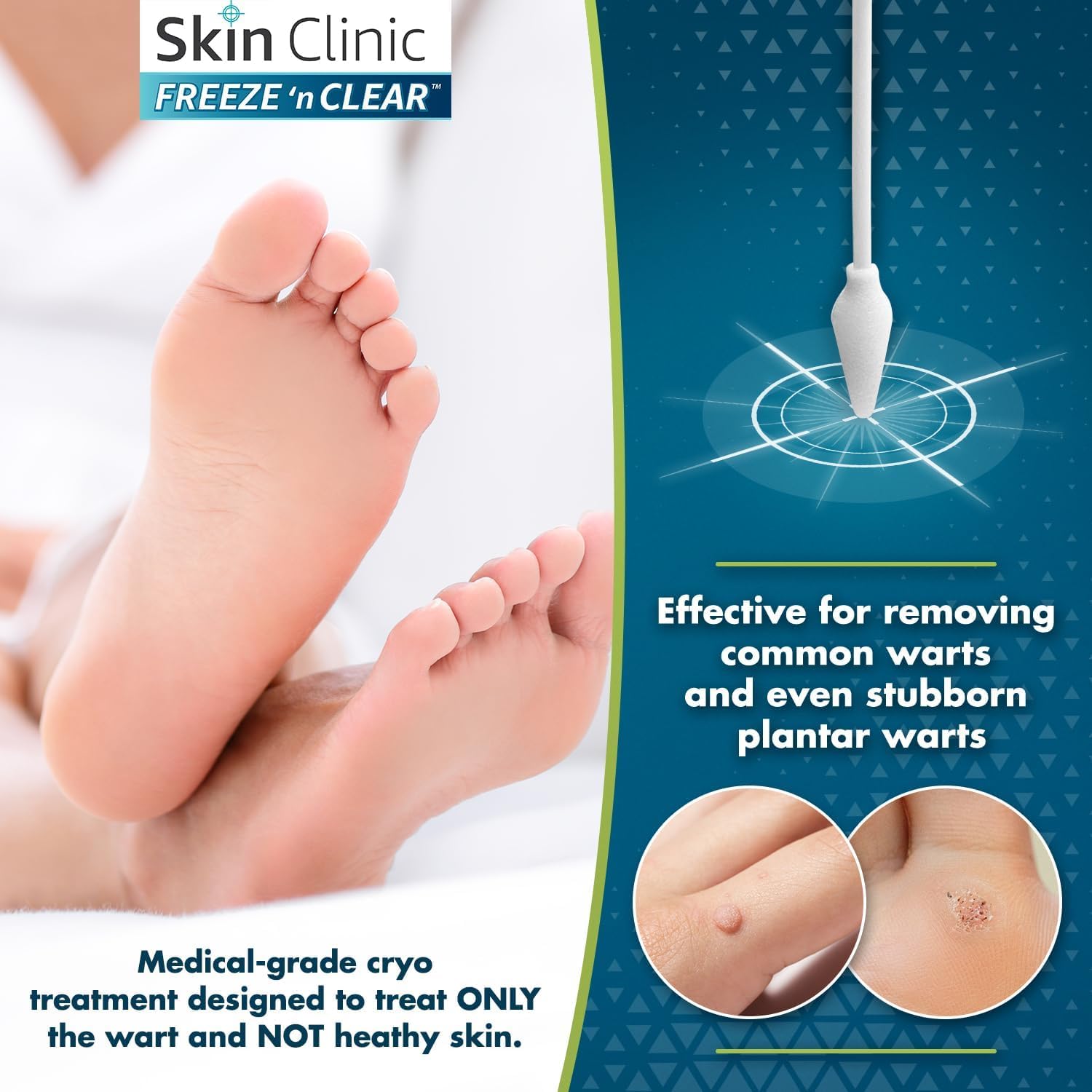 Skin Clinic FREEZE 'n CLEAR comparación de tamaño de aplicadores junto a moneda, escala clara