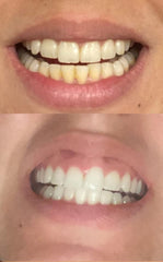 Smile Titan gel aplicado en bandeja dental durante uso, resultado cómodo y controlado
