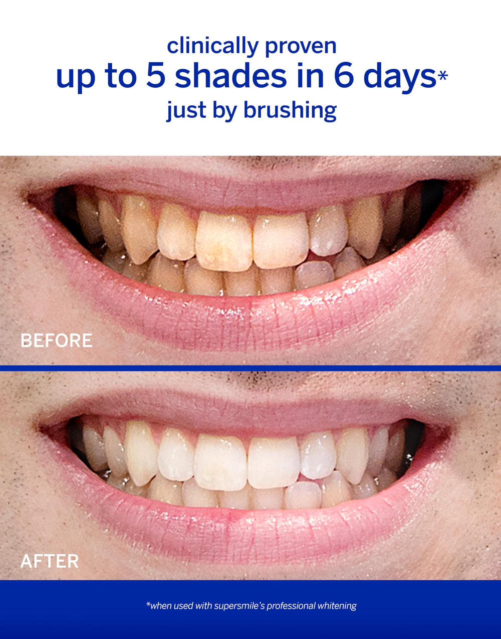Supersmile etiqueta con Calprox y flúor, destaca protección y blanqueo seguro