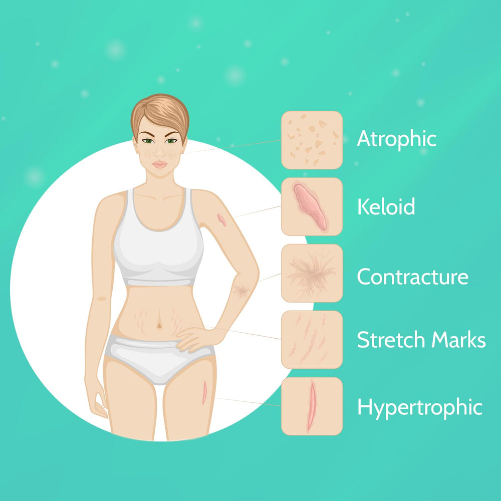 Wewell aplicación sobre abdomen, demuestra uso en cicatrices de cesárea