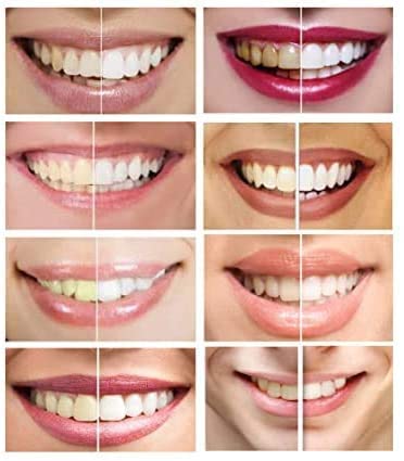 White Teeth Global jeringa junto a regla para comparar tamaño y dosificación fácil